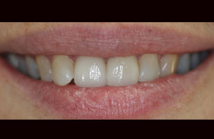 After — Whitening & repair