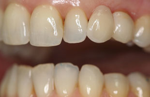 After — Crowns & veneers