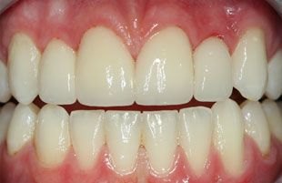 After — Full smile restoration
