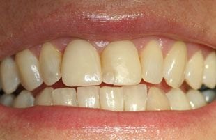 Before — Cosmetic makeover