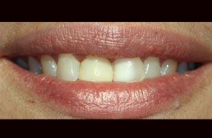 Before — Whitening & repair