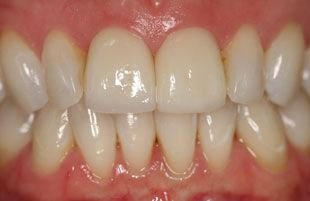 After — Cosmetic makeover