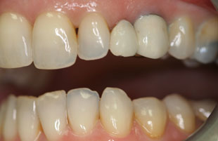 Before — Crowns & veneers