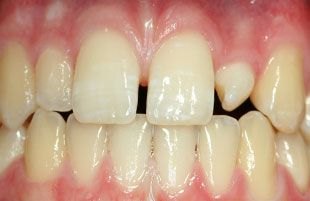 Before — Full smile restoration