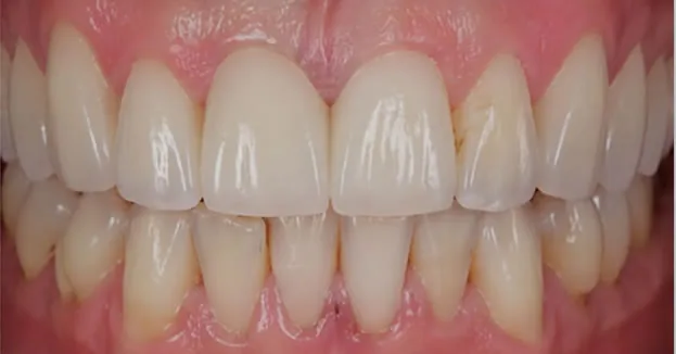 After dental bridge placement