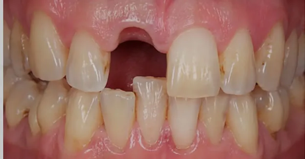Before dental bridge — missing tooth
