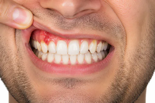 What are the symptoms or signs of gum disease?