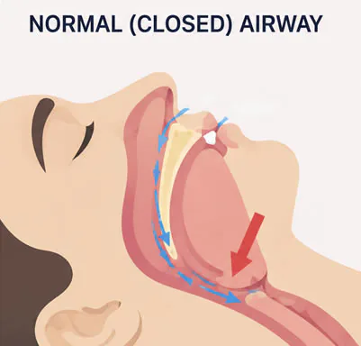 Closed Upper Airway