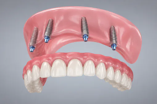 All-on-4 dental implants