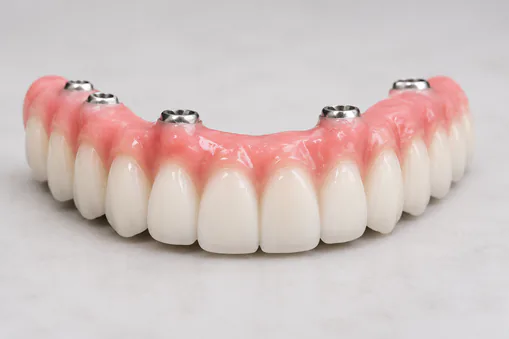 Implant supported denture