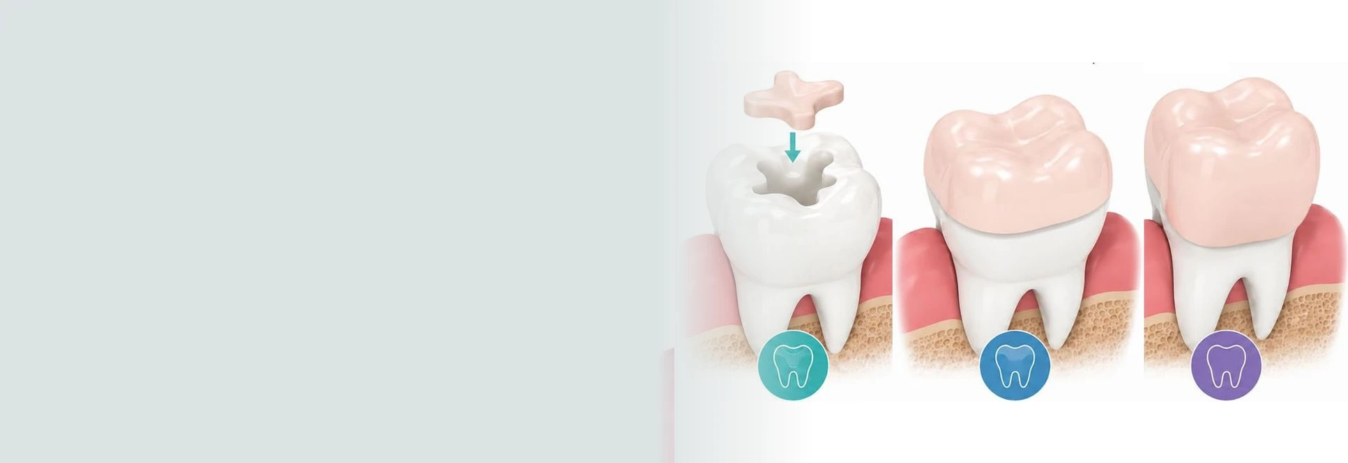 Dental inlays and onlays