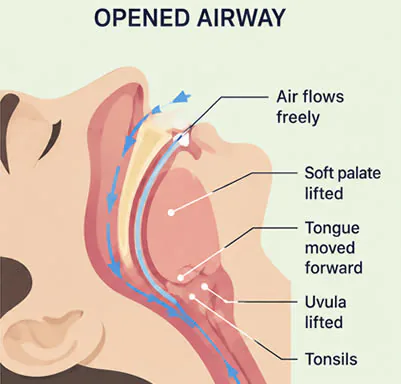Opened Upper Airway