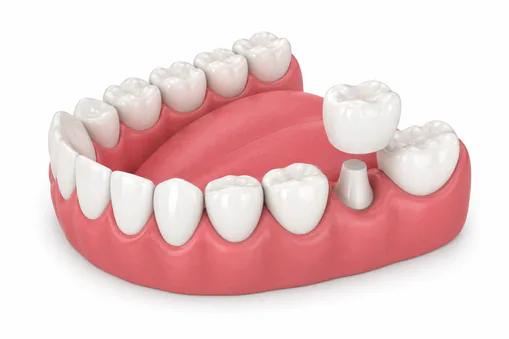 Dental crowns and bridges