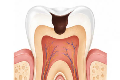 What is a cavity?