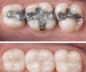 What are composite fillings?
